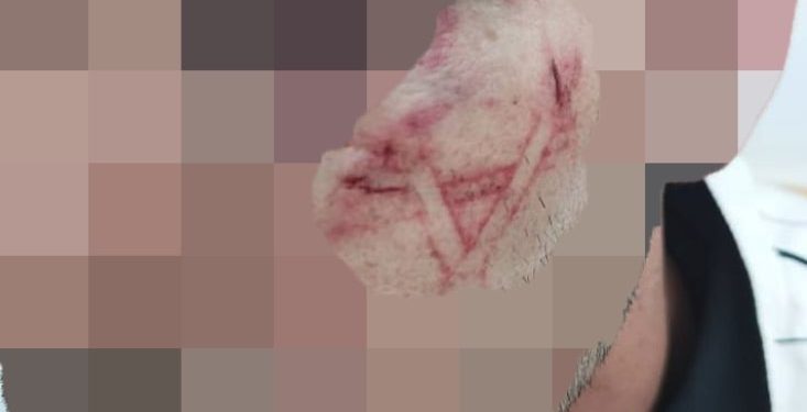 A Palestinian man who was detained by Israeli occupation forces in occupied Jerusalem has filed a complaint against the Israeli police, saying that they brutally beat him and branded the Star of David on his cheek.