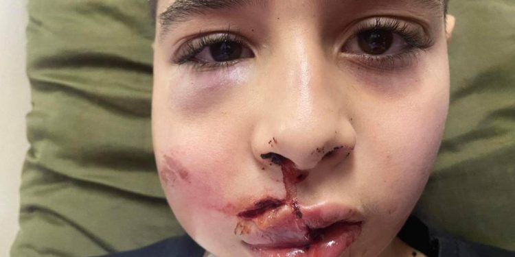 Israeli Settler’s Stone Smashes Innocent Face