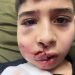Israeli Settler’s Stone Smashes Innocent Face