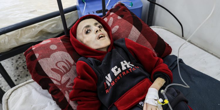 Surge in Child Malnutrition as Gaza Crisis Deepens