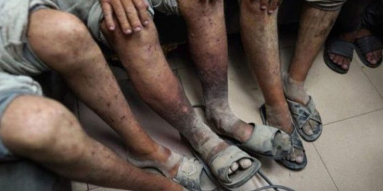 IPS Allows Scabies to Spread Among Palestinian Detainees, Haaretz Uncovers 