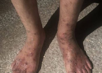 Health Catastrophe Looms As Scabies Ravaging Palestinians at Negev Prison