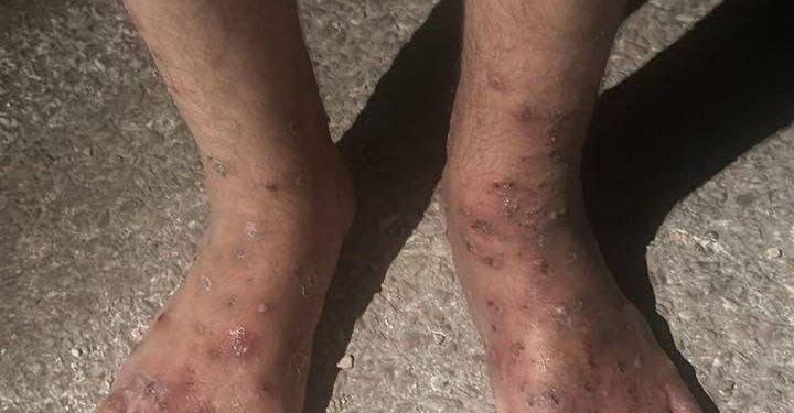 Health Catastrophe Looms As Scabies Ravaging Palestinians at Negev Prison