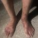 Health Catastrophe Looms As Scabies Ravaging Palestinians at Negev Prison