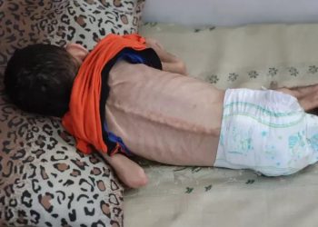 UNRWA: 66K Children in Gaza Suffering from Severe Malnutrition