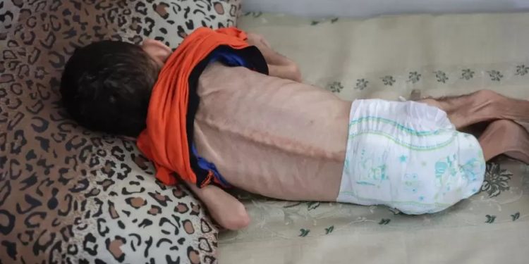 UNRWA: 66K Children in Gaza Suffering from Severe Malnutrition