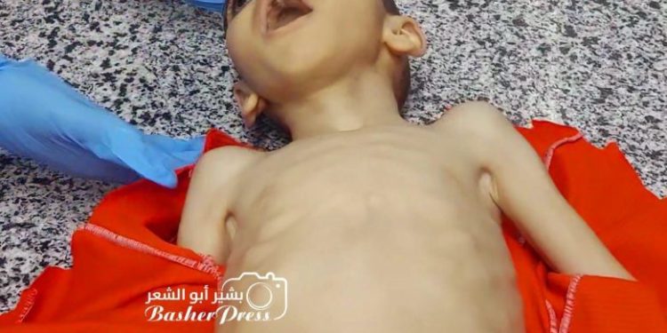 4-Year-Old Mustafa Dies of Hunger as Starvation Crisis Deepens