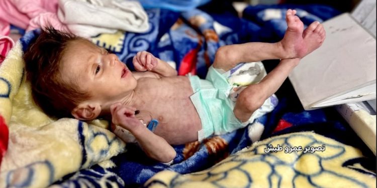 Baby Yousef Fights for Life with no Milk available