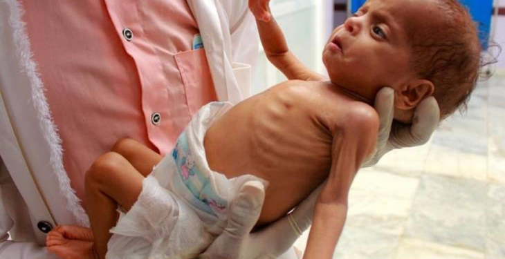 66 Children Dead from Starvation in Gaza
