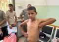 Wounds of War: Gaza’s Children Battle Skin Diseases Without Medicine