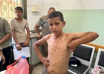 Wounds of War: Gaza’s Children Battle Skin Diseases Without Medicine