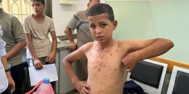 Wounds of War: Gaza’s Children Battle Skin Diseases Without Medicine