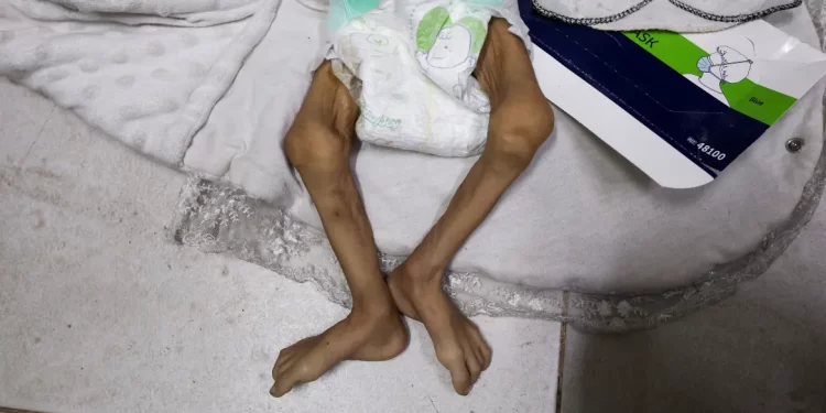 Israel’s Blockade Escalates Gaza Malnutrition Crisis, WHO Warns