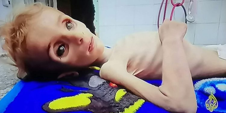 Infants Dying of Starvation in Gaza Amid Severe Famine, Inte’l Warnings