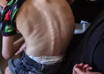 WHO: 12,000 Gaza Children Suffer from Acute Malnutrition 