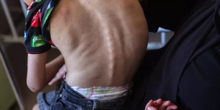 WHO: 12,000 Gaza Children Suffer from Acute Malnutrition 