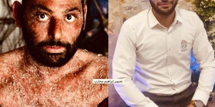 Rare Skin Disease Threatens Displaced Palestinian Man in Gaza