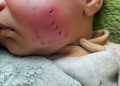 Gaza Newborn Injured in Rat Attack Inside Displacement Tent