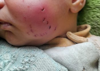 Gaza Newborn Injured in Rat Attack Inside Displacement Tent