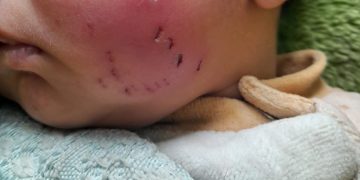 Gaza Newborn Injured in Rat Attack Inside Displacement Tent