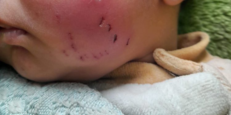 Gaza Newborn Injured in Rat Attack Inside Displacement Tent