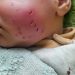 Gaza Newborn Injured in Rat Attack Inside Displacement Tent