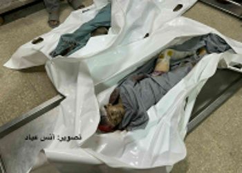 Burned Child Survives Gaza Strike with Entire Family Killed
