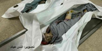 Burned Child Survives Gaza Strike with Entire Family Killed