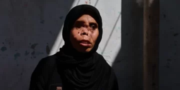 Gaza Mother Faces a New Life After Losing Her Eye and Daughter in an Israeli Airstrike