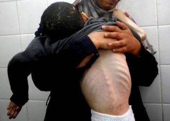 Al-Shifa Director: Gaza’s Miscarriage Rates Surge to 60–70%