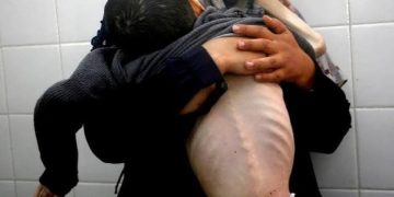 Al-Shifa Director: Gaza’s Miscarriage Rates Surge to 60–70%